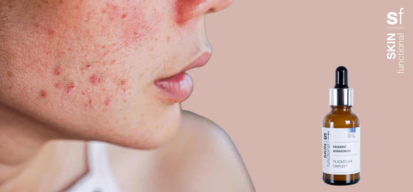 SKIN functional introduces the revolutionary 2% Acnoclear Complex™ for breakout management and inflammation relief