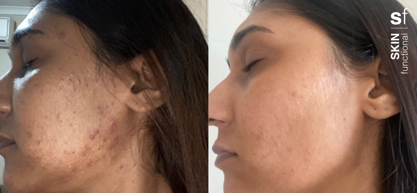 June is Acne Awareness Month: Clear skin starts with the Ultimate Breakouts range from SKIN functional