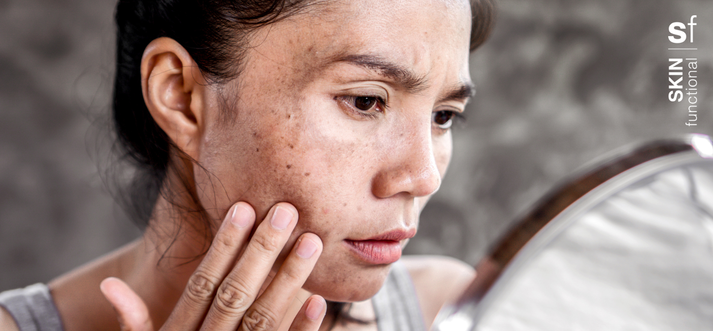 All about skin hyperpigmentation