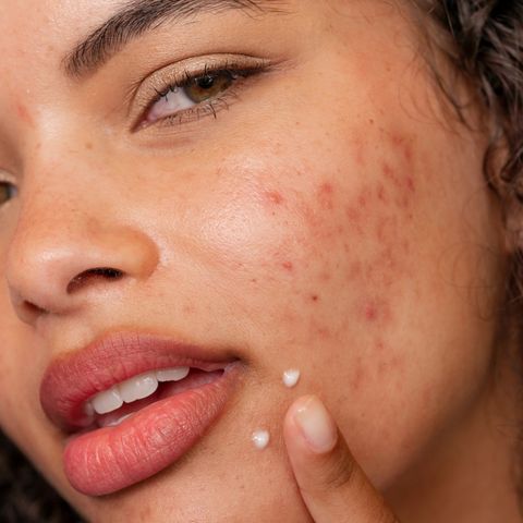 Close-up of a person applying cream to their face with visible acne.