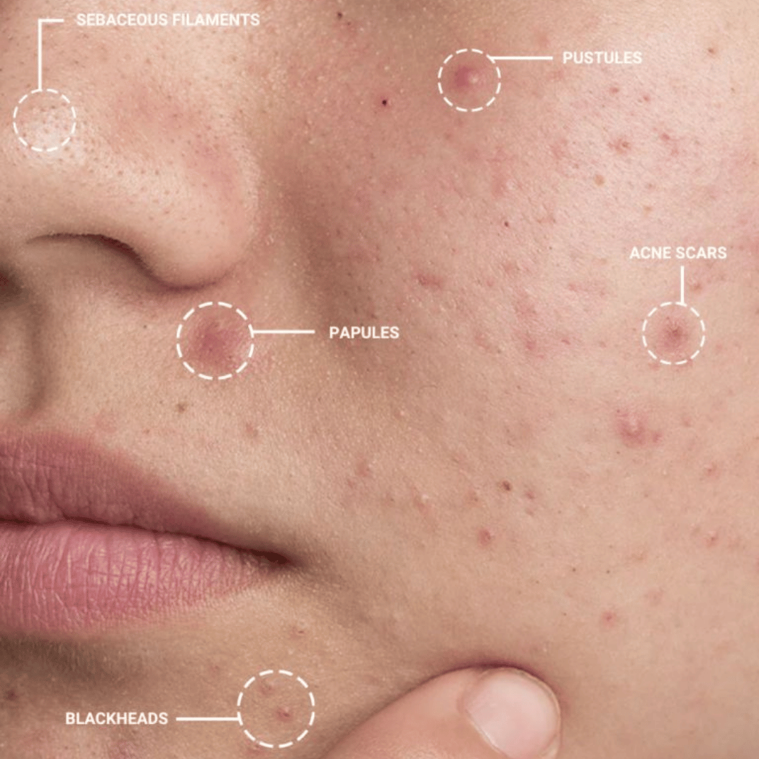 Acne-prone skin with labeled acne types on a close-up of a person's face.