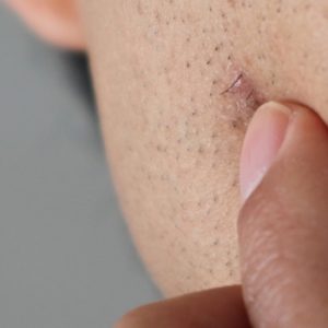 Ingrown Hairs