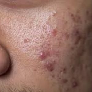 Acne Prone/Oily Skin