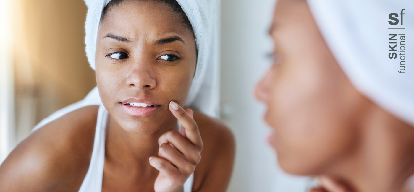 Everything you need to know about Skin Breakouts